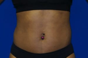 CoolSculpting® Before and After Pictures Augusta, GA