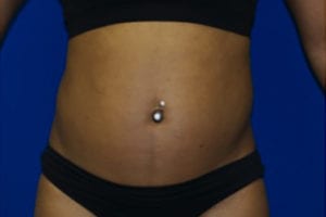 CoolSculpting® Before and After Pictures Augusta, GA