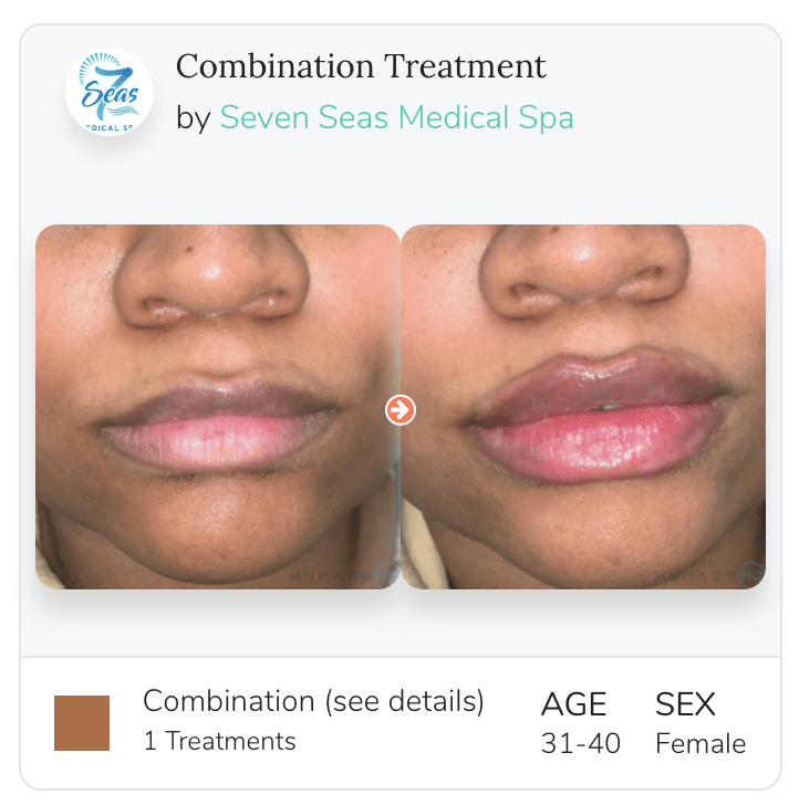 Lip Injections in Augusta & Grovetown, GA