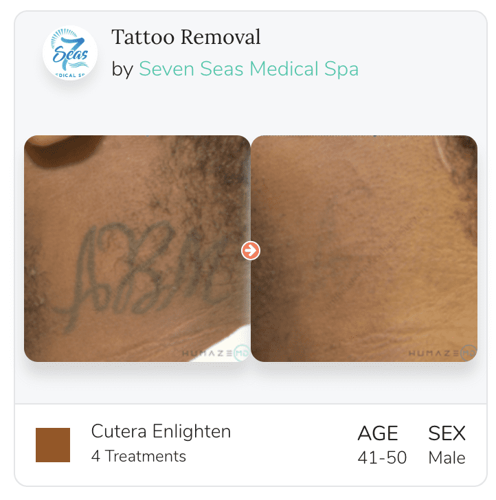 Enlighten Laser Tattoo Removal in Augusta & Grovetown, GA